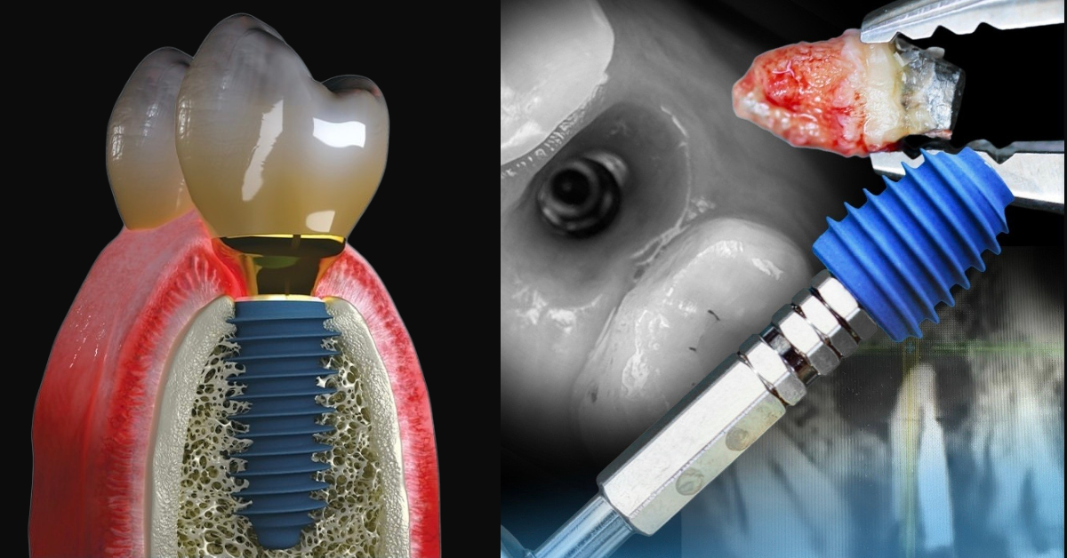 Clinica ImplantFix - Înlocuirea unui dinte