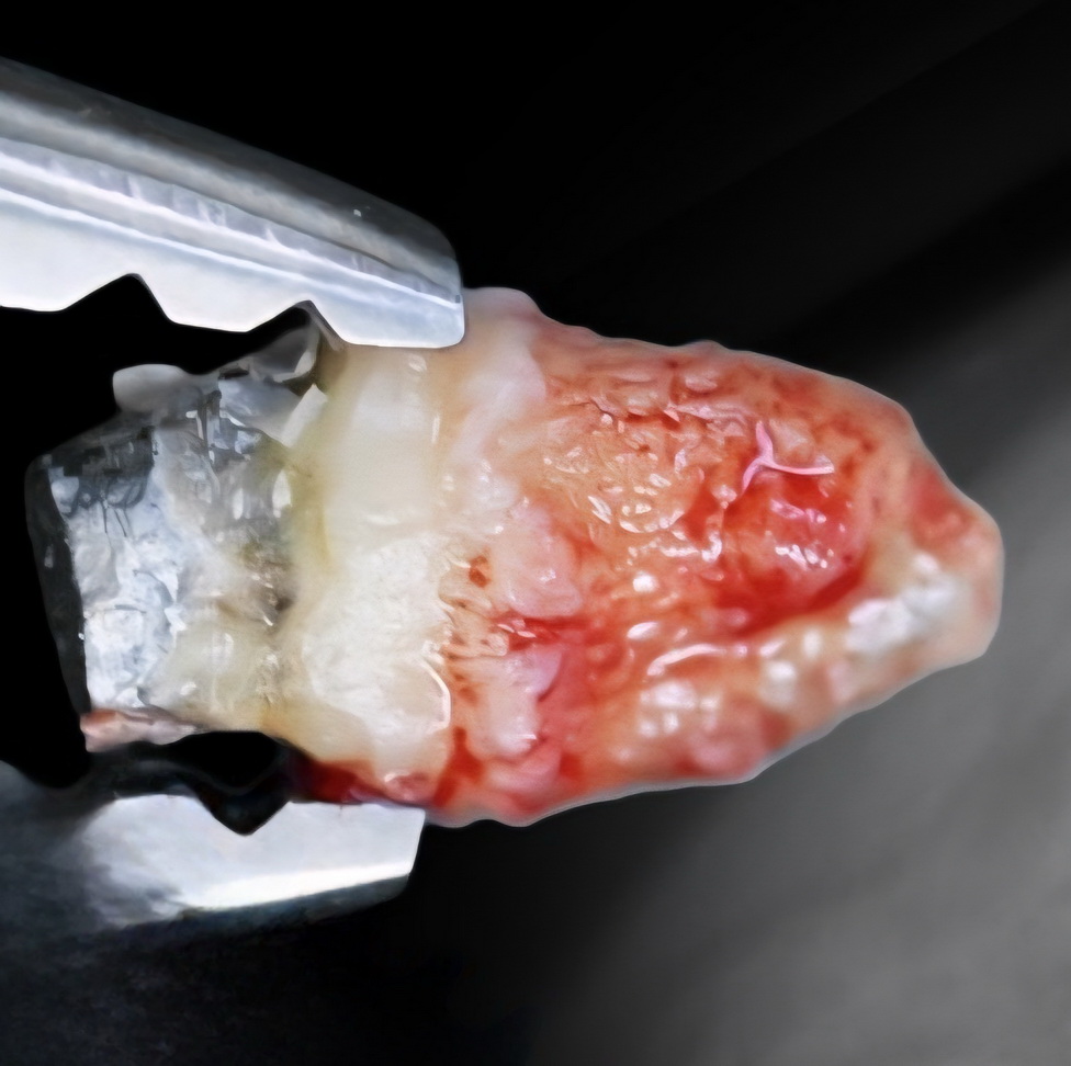 Extracție dentară
